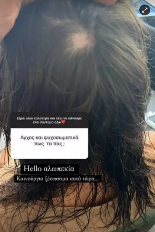 alopekia