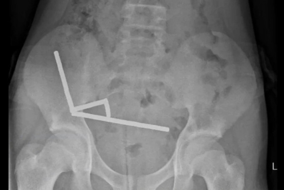 Γιατροί αφαίρεσαν δεκάδες μαγνήτες από τα έντερα 13χρονου