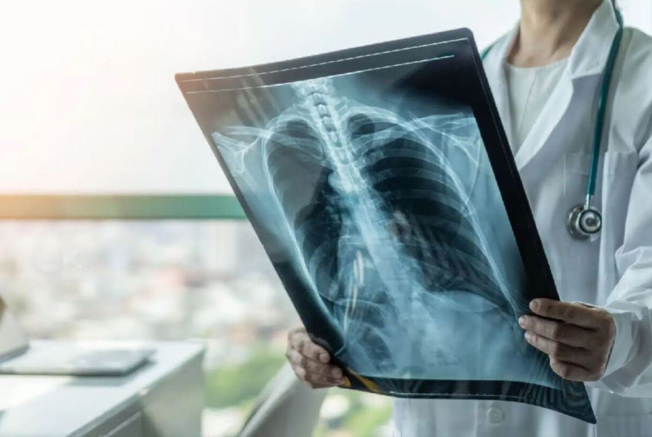 Η φυματίωση παραμένει η φονικότερη μολυσματική νόσος παγκοσμίως