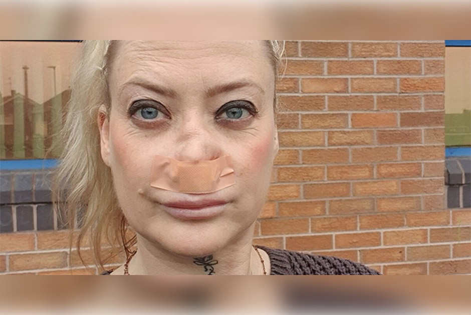 Βρετανίδα πήγε στην Τουρκία για νέα δόντια και παραμορφώθηκε