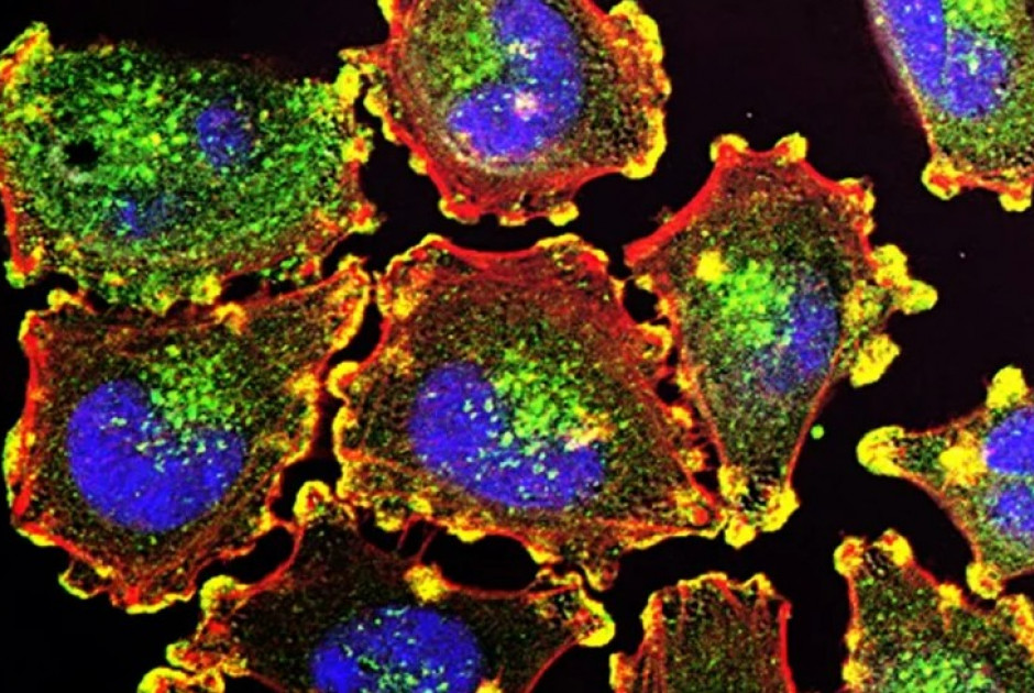 ΠΟΥ: Καρκίνος της ουροδόχου κύστης - Αυξημένος κίνδυνος για άτομα με αχρωματοψία