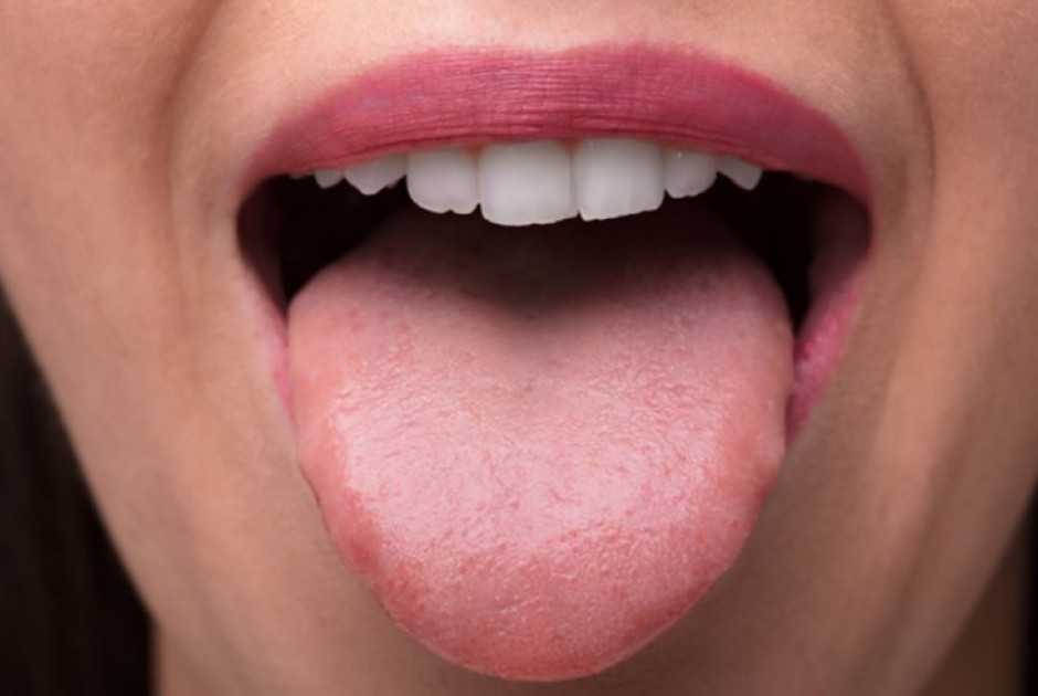 Γλώσσα: Προσφέρει πολύτιμες πληροφορίες για την υγεία - Ποια σημάδια μαρτυρούν σοβαρή ασθένεια