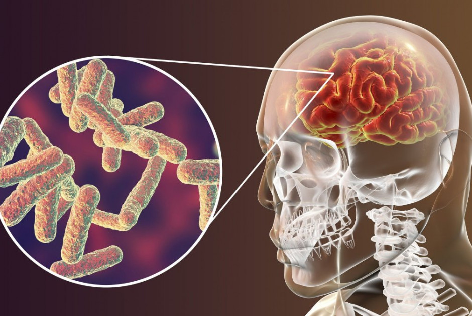 Lancet: Η μηνιγγίτιδα σκοτώνει πάνω από 250.000 ανθρώπους παγκοσμίως κάθε χρόνο
